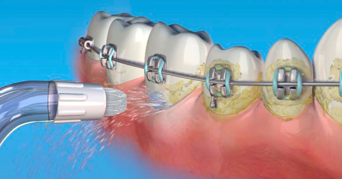 Portable Water Flosser — Deep Clean Anywhere, Anytime | The Complete Dental Travel Kit